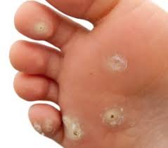 But a wart that grows in a spot where you put pressure, such as on a. What Are The Causes Of Warts