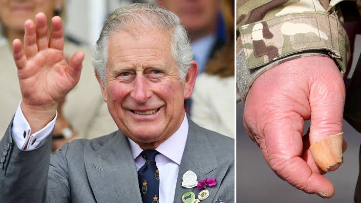 What happened to King Charles' fingers? - Heart