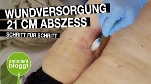 Erst zugsalbe drauf, in meinem fall ichtholan für 1 bis 2 tage, dann wird an der dünnen haut mit einer nadel geöffnet, eiter durch auseinanderziehen (nicht drücken!) entfernt und die wunde mit wundpflaster und betaisodona geschützt. 21cm Grosser Abszess Moderne Wundversorgung Schritt Fur Schritt Youtube