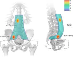 However, as with other types of cancer,. 11c Choline Pet Guided Salvage Radiation Therapy For Isolated Pelvic And Paraortic Nodal Recurrence Of Prostate Cancer After Radical Prostatectomy Rationale And Early Genitourinary Or Gastrointestinal Toxicities Advances In Radiation Oncology