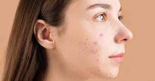 Image result for acne face