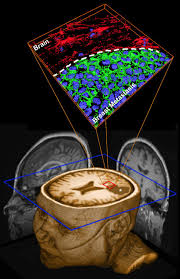 When breast cancer spreads to the brain it is considered stage 4 or metastatic breast cancer. Human Breast Cancer Metastases To The Brain Display Gabaergic Properties In The Neural Niche Pnas