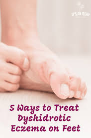 5 Ways To Treat Dyshidrotic Eczema On Feet How To Treat Eczema Eczema Severe Eczema
