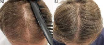 It is a weak progestogen and is found in some oral contraceptives (the pill). Prescribing Habits For Androgenic Alopecia Among Dermatologists In Spain In 2017 A Cross Sectional Study Sciencedirect