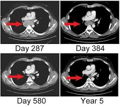 Tumor Regression After Combine Image Eurekalert Science News Releases