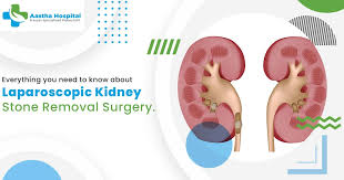 Everything You Need To Know About Laparoscopic Kidney Stone Removal Surgery