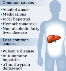 Causes Of High Liver Enzymes High Liver Enzymes Elevated Liver Enzymes Liver