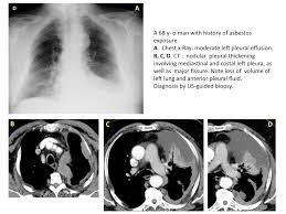 A doctor places a catheter inside the pleural cavity to drain fluid. Epos Trade