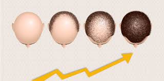 Patients typically recover quickly from this outpatient procedure and see the full results of their transplant within 12 months. Hair Transplant How Fast Does Hair Grow After With Pictures
