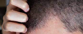 التهاب فروة الرأس أسباب عديدة ويب طب