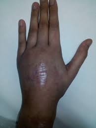 Mar 04, 2014 · wet gangrene results from severe bacterial infection superimposed on necrosis. Cureus Frightening Resistant Clostridial Myonecrosis A Case Report