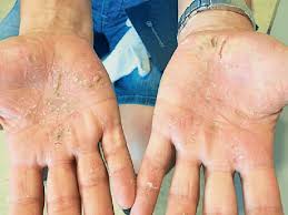 Image result for dermatitis contacta
