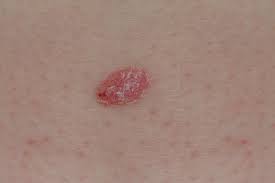 Melanoma cells that pass through the lymphatic system before entering the bloodstream spread and form new tumors more readily than cells that directly enter the bloodstream, a recent study shows. Psoriasis Or Skin Cancer How To Tell The Difference