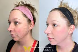 Nabi Medical Aesthetics added a...