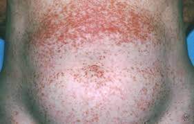 A hives rash can last for weeks if not treated properly, however most cases only last several days or as little as several hours if you are lucky enough to have a less severe hives outbreak. Hives Altamont Ny Dermatologist