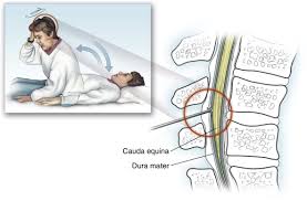 Image result for Spinal Headache