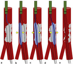 Veryan, biotronik, boston scientific corp., cook medical, . Efficacy Of Multichannel Balloon Angioplasty In Calcified Common Femoral Artery Lesions Sciencedirect
