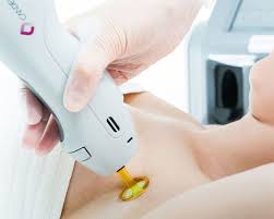 Of course no hair removal method is perfect which is why there are also some cons to laser hair removal which you should keep in mind when deciding if you want to get this treatment. Why The Candela Laser For Hair Removal Is The Gold Standard