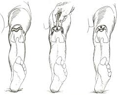 Image result for Ballottable Patella Sign