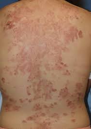 Image result for Pemphigus