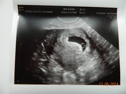 Trebuie inteles ca sarcina oprita a fost cu mare probabilitate o intamplare, fara a avea adesea, in cazul sarcinii oprite din evolutie nu apare niciun simptom sau simptomele. Unpiticatatdemic Vreau Si Eu Un Bebe Pagina 3