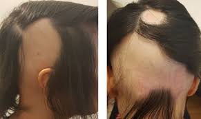 See the progression, causes, and treatments for this distressing it ranges from normal hair density to a bald crown, which is rare. Diet And Microbiome Influence On Alopecia Areata Experience From Case Reports