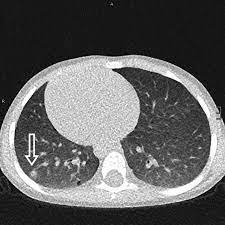 Maybe you would like to learn more about one of these? Pulmonary Granulomatosis Of Genetic Origin European Respiratory Society