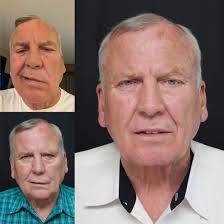 🤩🤩 THE POWER OF EMFACE 🤩🤩 This patient had Bells Palsy and was treated  with @emface at @thedentalstudioutah by Dr David Peterson! To say this  changes lives is an understatement!! He gained