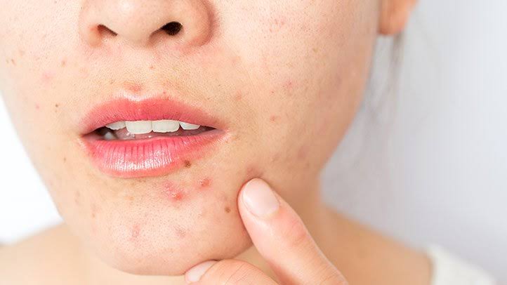 Image result for skin pimples