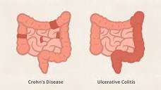 Crohn's Disease Versus Ulcerative Colitis: What's the Difference?