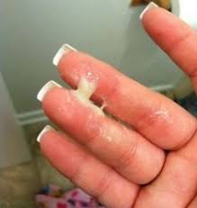 You have this kind of red plaque right in the fold and then beyond that these little red dots, which kind of look like little satellites. Pictures Of Yeast Infection Discharge Look Like 3 Days Evmp Wellness20 Site