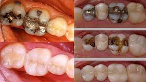 Pin On Tooth Decay
