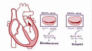 The most common cause of ms is rheumatic fever. Mitral Valve Disease Osmosis