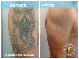 Storwick dermatology & laser clinic. How Does Laser Tattoo Removal Work In Calgary Flash Tattoo Removal Inc