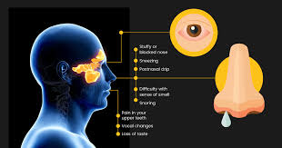 Find out about nasal polyps, which are painless soft growths inside your nose. Nasal Polyps Archives Diasurge Medical