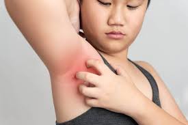 Cara ini dapat menghilangkan gatal yang disebabkan oleh dermatitis kontak, kudis, dan rambut yang tumbuh ke dalam atau ingrown hair. 4 Cara Mengobati Ketiak Gatal Dengan Bahan Alami