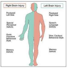 Right V Left Brain Injury Stroke Nurse Medical Knowledge Nursing Study