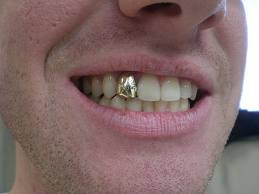 What are other people paying for one? Dental Crowns Dental Implants From 495 Dent1st Cosmetic Dentistry Dental Implant Centre