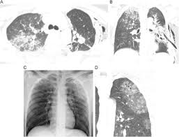 Image result for Pulmonary Contusion