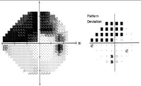 Image result for Visual Field Deficit