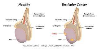 While testicular cancer can affect males of any age, it is most frequently diagnosed in young men ages 15 to 30 and is far less common among males over age 50. Testicular Cancer Treatment In India In Depth Explanation