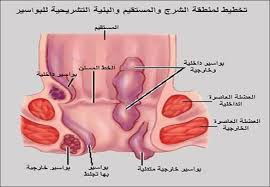 البواسير Hemorrhoids سببت البواسير هواة العلوم والتكنولوجيا Facebook