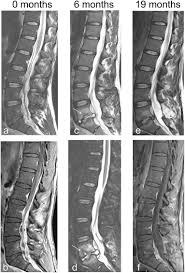 Image result for Spinal Epidural Abscess