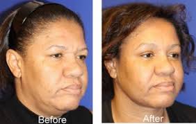 We did not find results for: Eyebrow Lift Long Island And New York City Dr Amiya Prasad