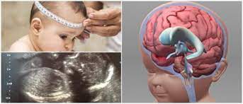 Normalmente, el líquido fluye a través de los ventrículos hacia la espina dorsal. Hidrocefalia Definicion Causas Sintomas Diagnostico Y Tratamiento Arriba Salud