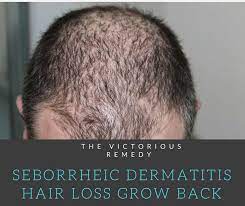 Human chorionic gonadotropin (hcg) is a hormone that has extremely beneficial effects on both males and females for very different reasons. Seborrheic Dermatitis Hair Loss Grow Back The Victorious Remedy Hair Loss Remedies Prevent Hair Loss Thick Hair Remedies