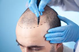 Hair Transplant Assistant Training