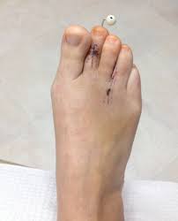 Five Weeks Post Op The K Wire Has Backed Out A Little And I Banged It A Few Times It S Also Spun Around About 45 Degre Foot Surgery Post Op Morton S Neuroma