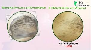 Alopecia areata targets the hair follicles from which individual hairs grow, slowing down or halting we have to know about the loss of eyebrow hair. Eyebrows Alopecia Areata Youtube