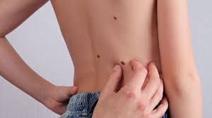 Dann sollst du zum hautarzt und sie da entfernen. Leberflecken Hautmale Bitte Beobachten Eltern De